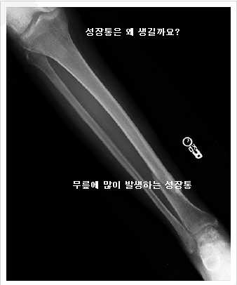 [김현일 원장의 한방칼럼]성장통의 대처법 및 한방치료 