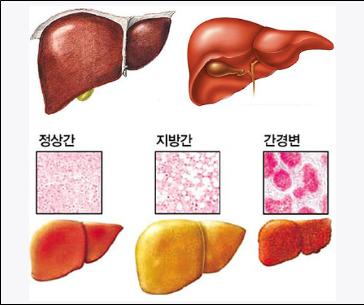 과식이 부르는 위장질환과 지방간 [한국건강관리협회 대구..