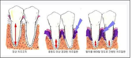 “스케일링, 꼭 해야 하나요?” [한국건강관리협회 대구..