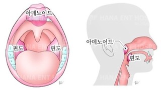 환절기 ‘편도선염’ 예방하려면??[건강상식] 한국건강관..